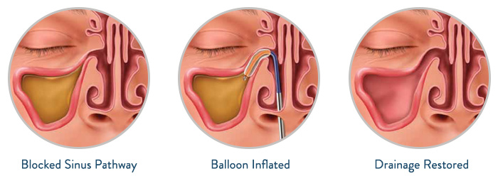Image result for balloon sinuplasty